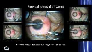 Ocular Loiasis Case Report with surgical removal [upl. by Grochow545]