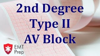 2nd Degree Type 2 AV Block ECG  EMTprepcom [upl. by Pallaten]