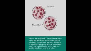 Sickle Cell Disease Hemoglobin S Disease [upl. by Llenod56]