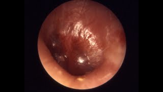 Ear infection when to give oral antibiotics [upl. by Naesal]