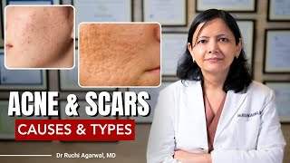 Acne amp Scars Causes amp Treatments  How to treat acne  Dr Ruchi Agarwal acnescarstreatment satya [upl. by Noelc167]