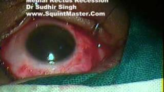 Medial Rectus Recession  Strabismus Surgery  Through Limbal Approach By Dr Sudhir Singh 3 [upl. by Thorvald]