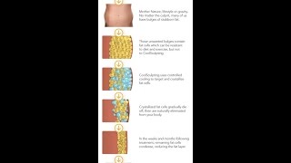 Coolsculpting vs Liposuction [upl. by Martinelli788]