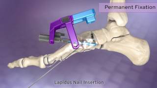 Phantom™ Small Bone Intramedullary Nail Lapidus Procedure [upl. by Breena791]