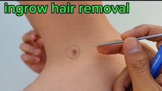 PLUCKING INGROWN BACK HAIR for Mr tqxcpobhy asmr [upl. by Retla]