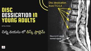 Disc Degeneration L5 S1 Disc Desiccation Disc Degeneration Causes DDDDegenerative Disc Treatment [upl. by Inalaek]