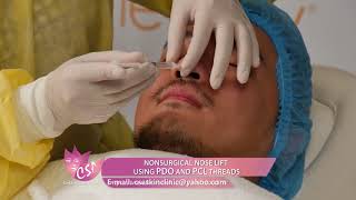 NONSURGICAL NOSE LIFT USING PDO AND PCL THREADS for men [upl. by Aklam]