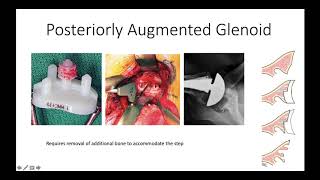 How To Do a Total Shoulder 5 Managing Glenoid Retroversion [upl. by Atteuqahc]