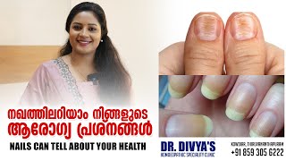 നഖത്തിലറിയാം നിങ്ങളുടെ ആരോഗ്യപ്രശ്നങ്ങൾ  Your Nails Can Tell About Your Health  Nails Warning [upl. by Anoirtac93]