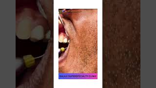 How To Use Laser In RCT Procedure  DR SANJEEB ROUT shorts ytshorts dentist drsanjeebrout rct [upl. by Okihcim]