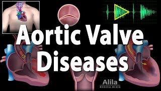 Aortic Valve Disease Animation [upl. by Ialohcin]