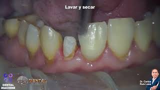 CEMENTACION DE CORONA DE ZIRCONIO CON CEMENTO AUTOADHESIVO [upl. by Narik215]