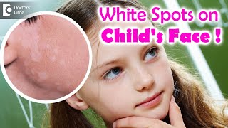 5 Things to know if your child is suffering from Pityriasis Alba  Dr Divya SharmaDoctors Circle [upl. by Prem49]