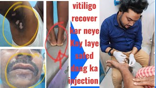 fast ⏩ vitiligo treatment  safed daag ka fast ⏩recover kar neye Kay leye injection vitiligocure [upl. by Neimad523]