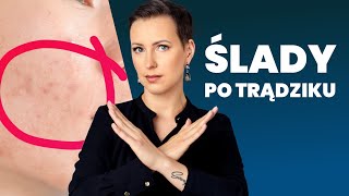 Blizny i przebarwienia po trądziku  jak się ich pozbyć [upl. by Dielle]