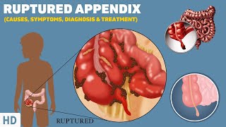 Ruptured Appendix What It Feels Like and How to Recognize the Symptoms [upl. by Upali151]