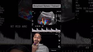 Ultrasound Doppler Waveforms neetpg inicet aiims [upl. by Cyma121]