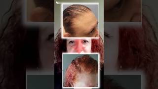 Hair Restoration Expert Shares Her Journey with Stunning Results hairgrowthjourney healthyhair [upl. by Rosina]