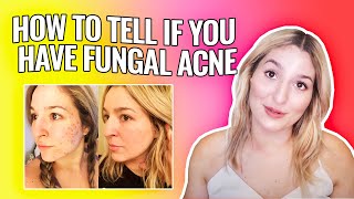 How to tell if you have FUNGAL ACNE  Malassezia Folliculitis [upl. by Werdma865]