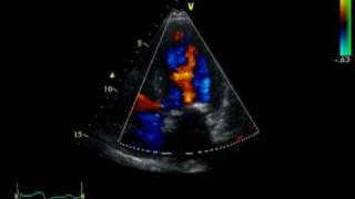 HOCM  AORTIC STENOSIS  LVOT FLOW [upl. by Gnet]