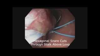 Endoscopic loop to Aid in Pedunculated Polyp Removal [upl. by Skye772]