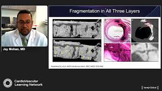 Utilizing Intravascular Lithotripsy for Large Bore Access in TAVR and TAVI Procedures [upl. by Artemas]