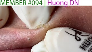 Acne Treatment Huong Da Nang 094  Member  Huong [upl. by Farkas]