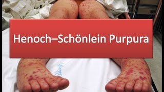 HenochSchönlein Purpura [upl. by Meehsar]