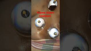 Hijama Islamic treatment [upl. by Ataeb]