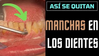 Asi se quitan las MANCHAS de los DIENTES en el DENTISTA  Limpieza dental [upl. by Ailisec]