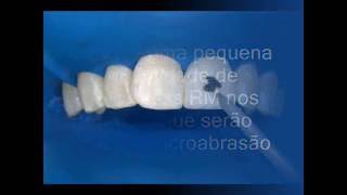 Microabrasão dentária 【ツ】Dentista Sorridere [upl. by Willman]