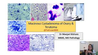 mucinous cystadenoma ovary amp teratoma ovary [upl. by Mihsah147]