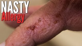 Nasty Skin Reaction From Sawdust  Contact Dermatitis [upl. by Aohsoj]