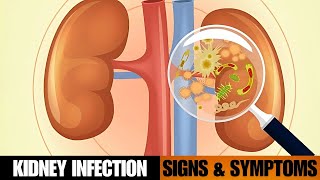 KIDNEY INFECTION Pyelonephritis Signs amp Symptoms [upl. by Desberg859]