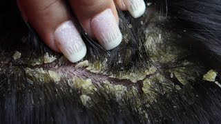 dandruff removal huge flakes scratching on head34 [upl. by Gninnahc]