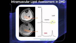 ImagingDMD MRI Study 32012 [upl. by Cody]