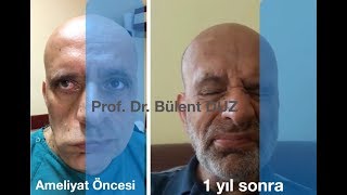 Yüz felci ameliyatı  Prof Dr Bülent DÜZ [upl. by Ilowell]