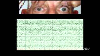 Alternating ictal and postictal nystagmus [upl. by Nodarse474]