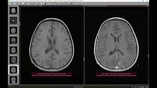 CNS tuberculoma [upl. by Nonnelg]