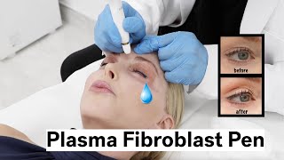 Plasma Fibroblast Pen to Treat Crepey Eyelids and Crows Feet Over 50 [upl. by Ednutey]