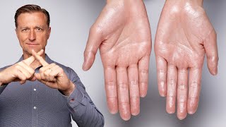 How to Stop Excessive Sweating Hyperhidrosis [upl. by Castillo]