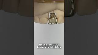 Cementing a Gold Facing dental teeth smile shorts shortvideo gold implant implants cement [upl. by Nivrem890]