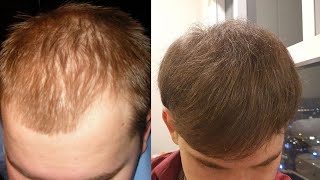 Is Ketoconazole Shampoo Effective Against Scalp Inflammation [upl. by Nilyak]