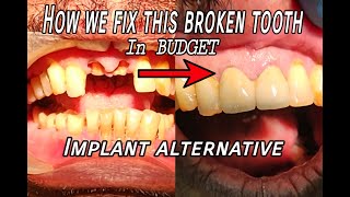 Broken Front Teeth Treatment  Implant Alternative In Budget  Post amp Core Build Up with Crown [upl. by Posehn]