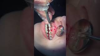 Gingivectomy for orthodontics treatment [upl. by Ailefo]