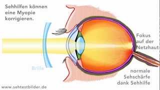Myopie Kurzsichtigkeit [upl. by Warfeld]
