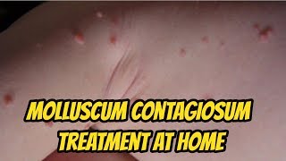 Molluscum contagiosum Treatment At Home [upl. by Leyla]