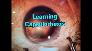 Learning capsulorhexis  Cataract Surgery by Pedro Cabral MD [upl. by Sinnal]