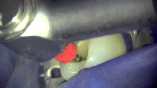 ProGlider and ProTaper Next DentsplyMaillefer Case Report 1 [upl. by Naujid]