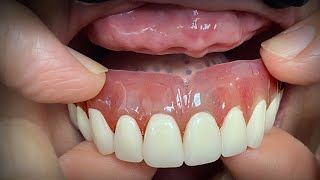 Finalizing a Highly Esthetic Denture with Dentist amp Patient InLab [upl. by Ecidnarb]